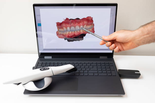 Dental Inlays and Onlays